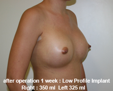plastic-surgery-breast-augmentation